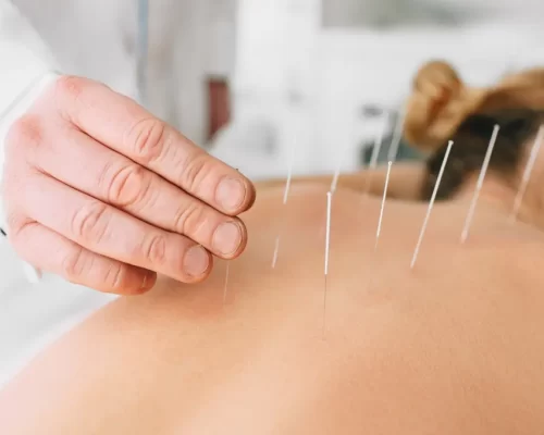 Dry Needling Therapy